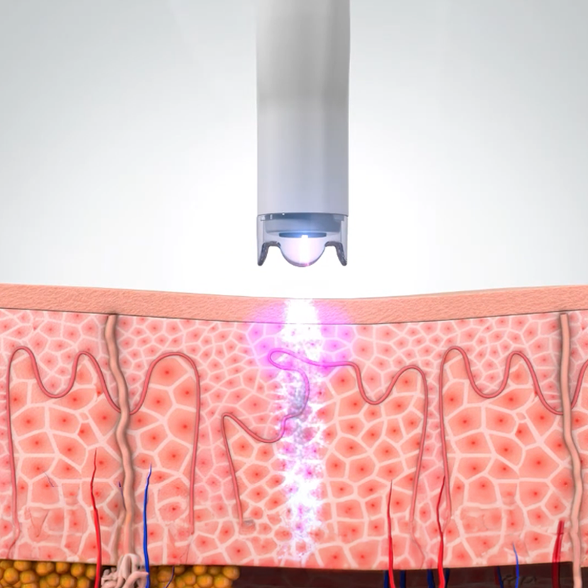 ION Medical Plasma Device